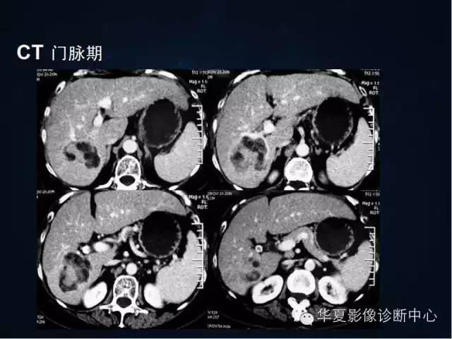 【病例学习】原发性肝癌伴脂肪变性一例影像表现