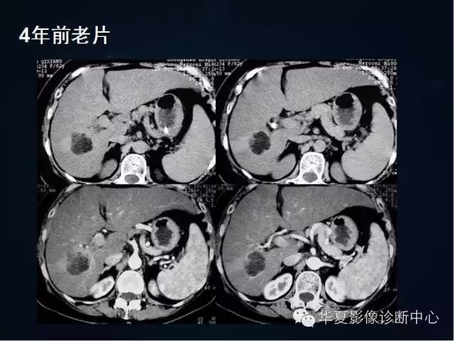 【病例学习】原发性肝癌伴脂肪变性一例影像表现