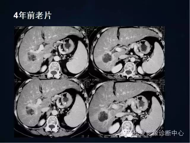 【病例学习】原发性肝癌伴脂肪变性一例影像表现
