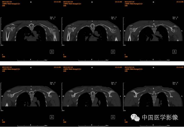 【病例学习】肱骨骨软骨瘤一例CT影像表现 【病例学习】肱骨骨软骨瘤一例CT影像表现