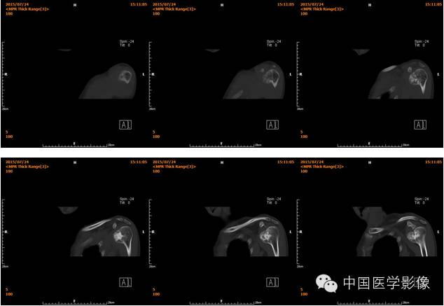 【病例学习】肱骨骨软骨瘤一例CT影像表现 【病例学习】肱骨骨软骨瘤一例CT影像表现