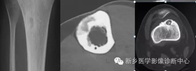 【一句话学影像】从“骨膜反应”看骨肿瘤良恶性