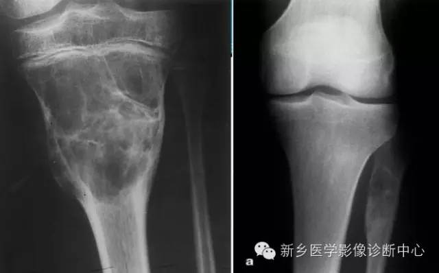 【一句话学影像】从“骨膜反应”看骨肿瘤良恶性