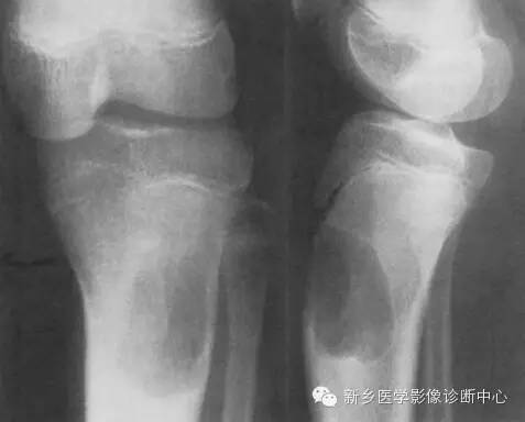 【一句话学影像】从“骨膜反应”看骨肿瘤良恶性