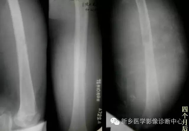 【一句话学影像】从“骨膜反应”看骨肿瘤良恶性
