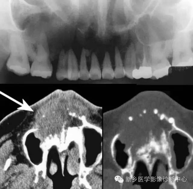 【一句话学影像】从“骨膜反应”看骨肿瘤良恶性