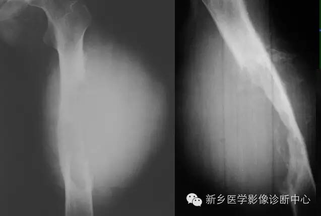 【一句话学影像】从“骨膜反应”看骨肿瘤良恶性