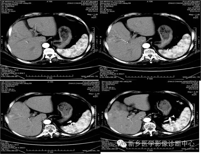 【病例学习】肝脏炎性假瘤一例影像表现 【病例学习】肝脏炎性假瘤一例影像表现