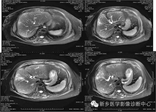 【病例学习】肝脏炎性假瘤一例影像表现 【病例学习】肝脏炎性假瘤一例影像表现