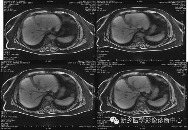 【病例学习】肝脏炎性假瘤一例影像表现 【病例学习】肝脏炎性假瘤一例影像表现