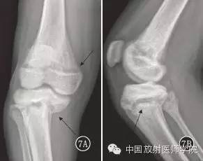 【病例学习】原发性高草酸尿症1例影像学表现 【病例学习】原发性高草酸尿症1例影像学表现