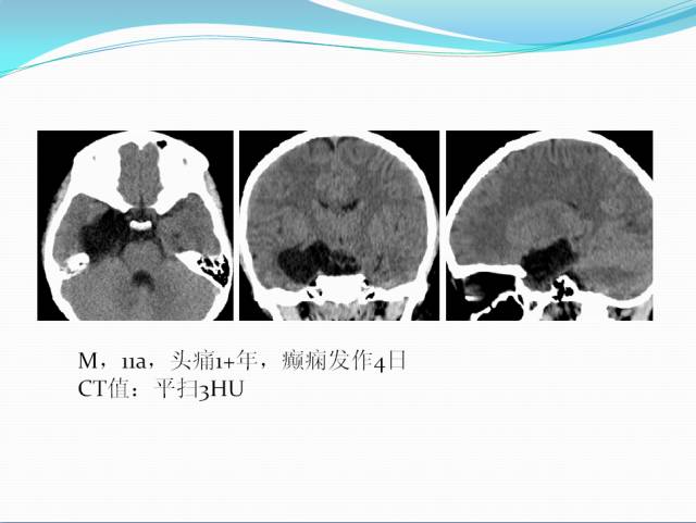 【病例学习】颅内表皮样囊肿CT及MRI表现