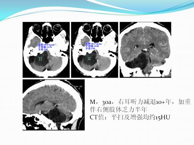 【病例学习】颅内表皮样囊肿CT及MRI表现