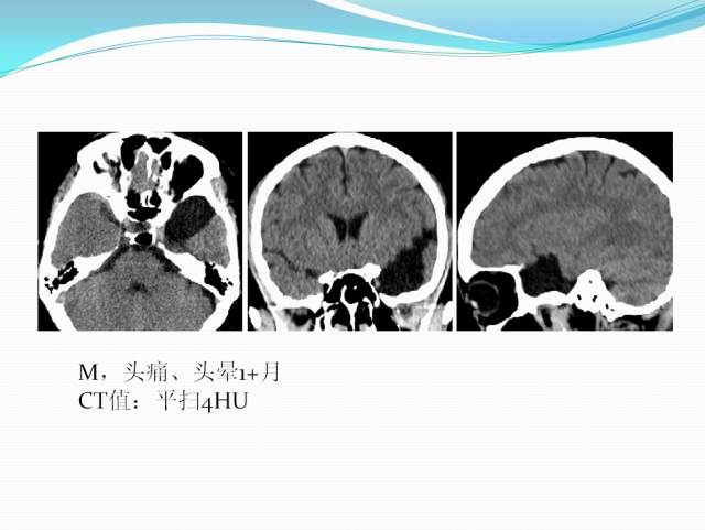 【病例学习】颅内表皮样囊肿CT及MRI表现