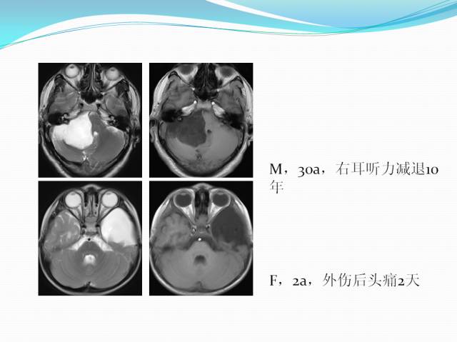 【病例学习】颅内表皮样囊肿CT及MRI表现