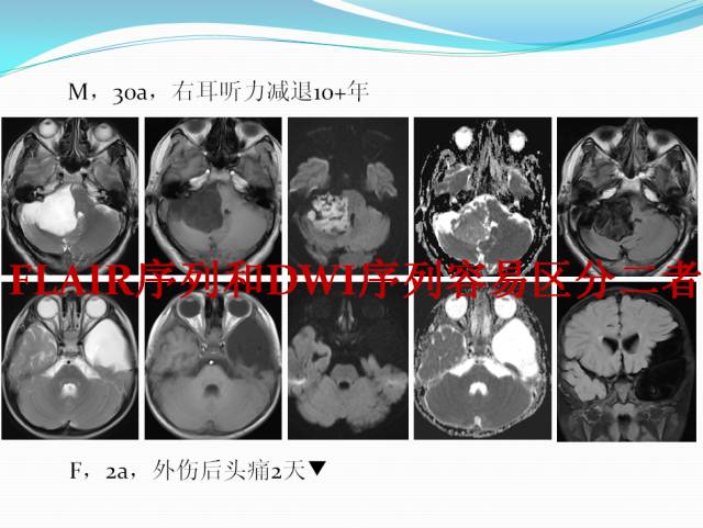 【病例学习】颅内表皮样囊肿CT及MRI表现