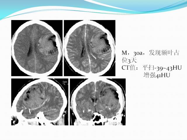 【病例学习】颅内表皮样囊肿CT及MRI表现