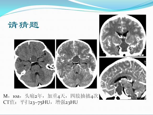 【病例学习】颅内表皮样囊肿CT及MRI表现