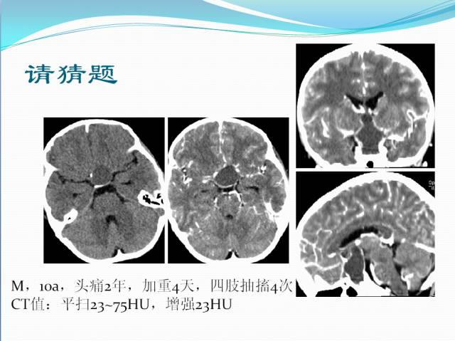 【病例学习】颅内表皮样囊肿CT及MRI表现