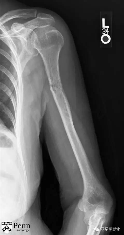 【双语病例】Pathologic fracture secondary to multiple myeloma