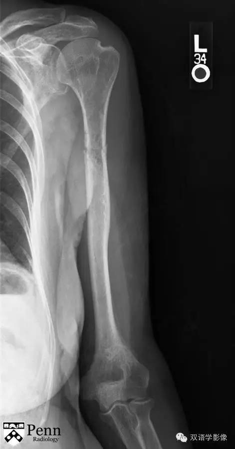 【双语病例】Pathologic fracture secondary to multiple myeloma