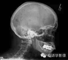【双语病例】Pathologic fracture secondary to multiple myeloma