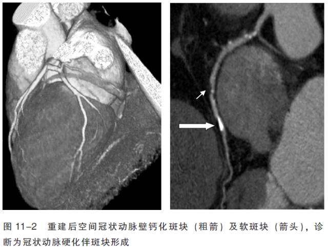 血管CT成像及常见疾病的影像诊断