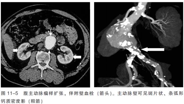 血管CT成像及常见疾病的影像诊断