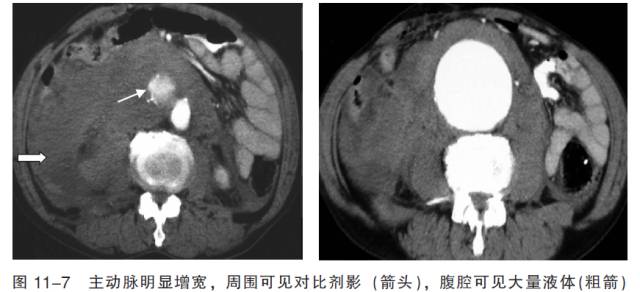 血管CT成像及常见疾病的影像诊断
