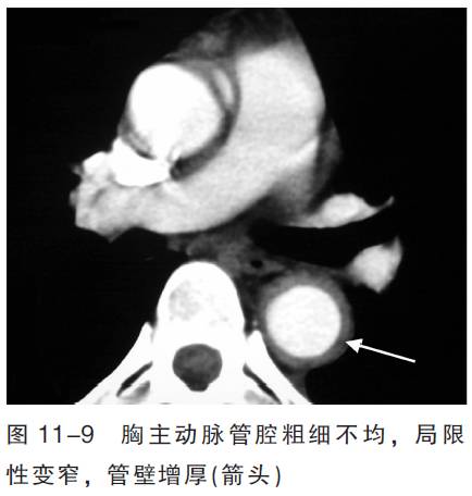 血管CT成像及常见疾病的影像诊断