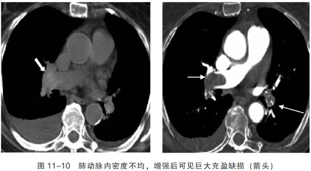 血管CT成像及常见疾病的影像诊断