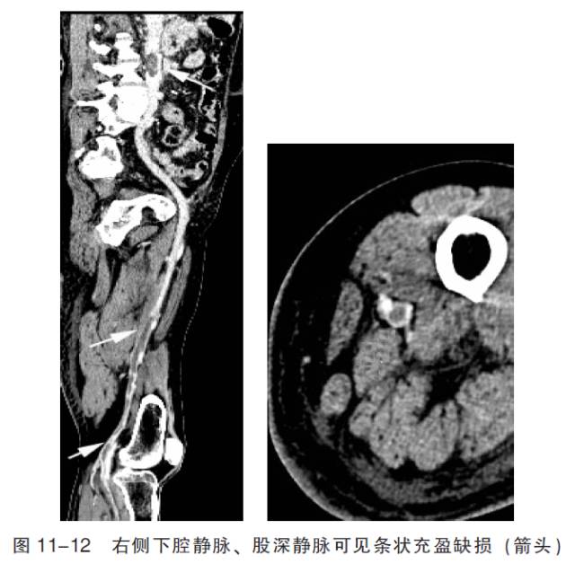 血管CT成像及常见疾病的影像诊断