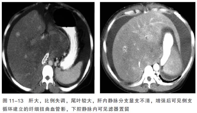 血管CT成像及常见疾病的影像诊断