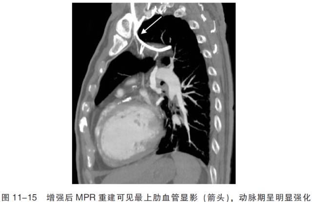 血管CT成像及常见疾病的影像诊断