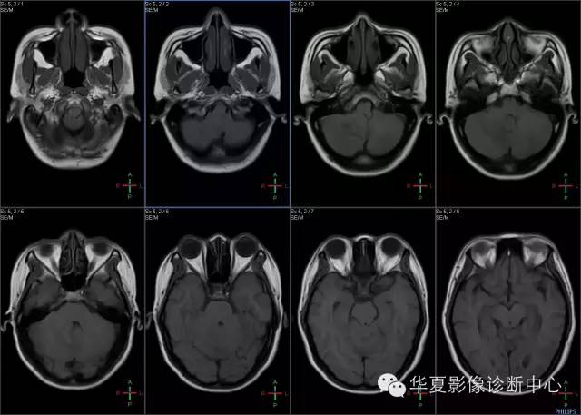 【病例学习】VHL综合征一例MR影像表现
