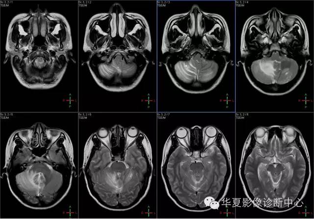 【病例学习】VHL综合征一例MR影像表现 【病例学习】VHL综合征一例MR影像表现