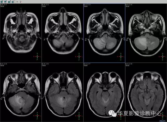 【病例学习】VHL综合征一例MR影像表现 【病例学习】VHL综合征一例MR影像表现