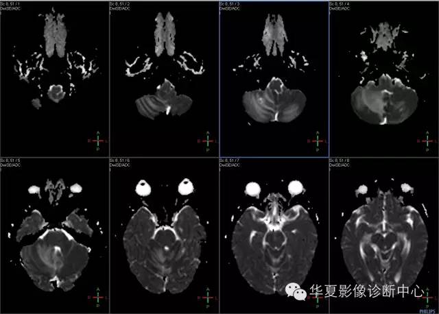 【病例学习】VHL综合征一例MR影像表现 【病例学习】VHL综合征一例MR影像表现