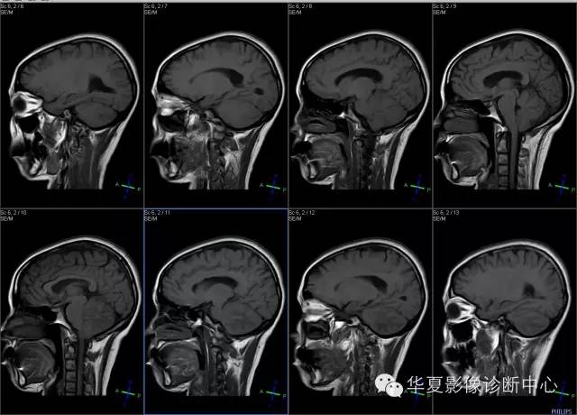 【病例学习】VHL综合征一例MR影像表现 【病例学习】VHL综合征一例MR影像表现