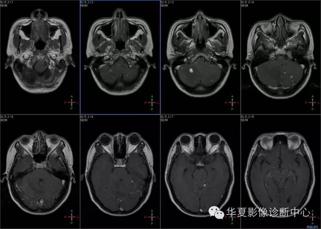 【病例学习】VHL综合征一例MR影像表现 【病例学习】VHL综合征一例MR影像表现