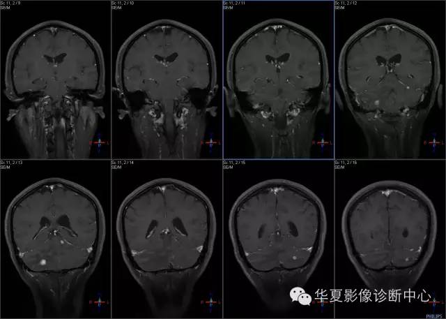 【病例学习】VHL综合征一例MR影像表现 【病例学习】VHL综合征一例MR影像表现