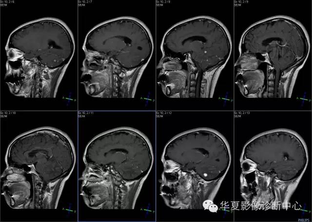 【病例学习】VHL综合征一例MR影像表现 【病例学习】VHL综合征一例MR影像表现
