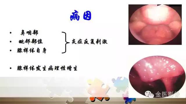 腺样体肥大的影像诊断