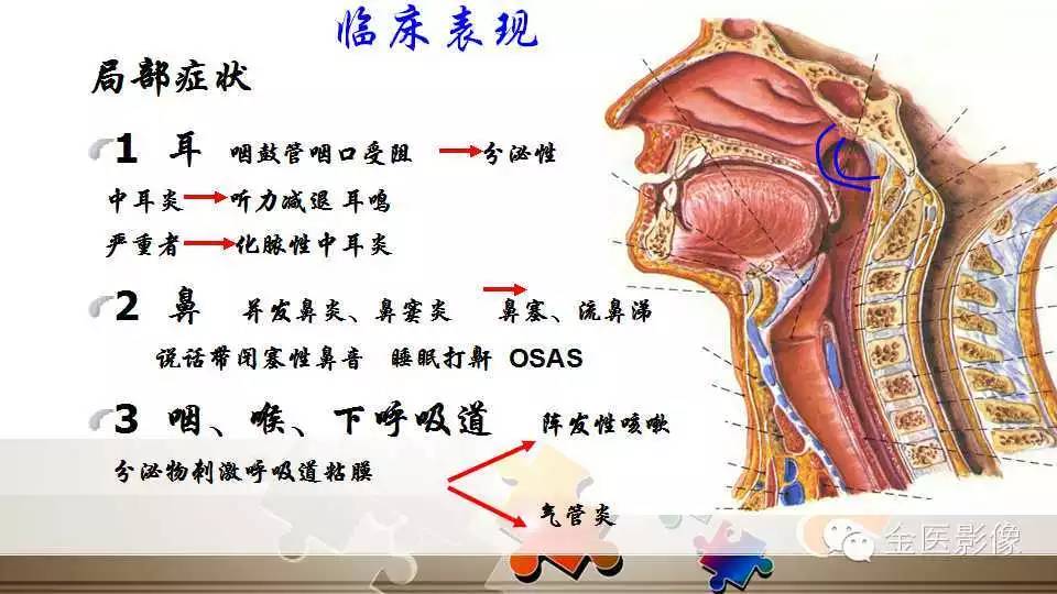腺样体肥大的影像诊断