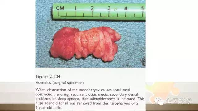 腺样体肥大的影像诊断