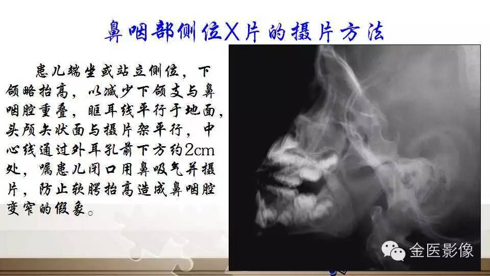 腺样体肥大的影像诊断