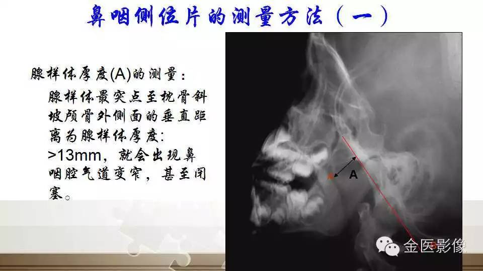 腺样体肥大的影像诊断