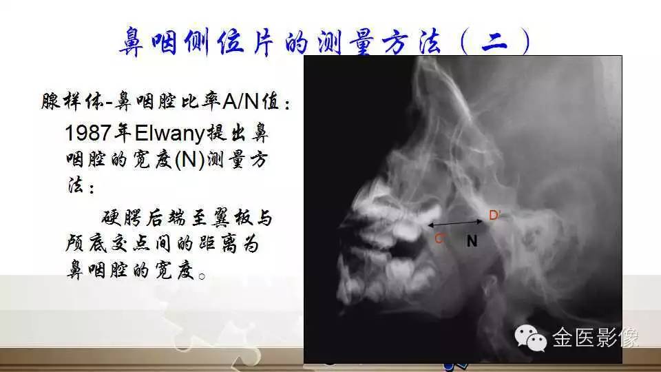 腺样体肥大的影像诊断