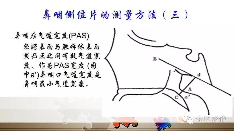 腺样体肥大的影像诊断