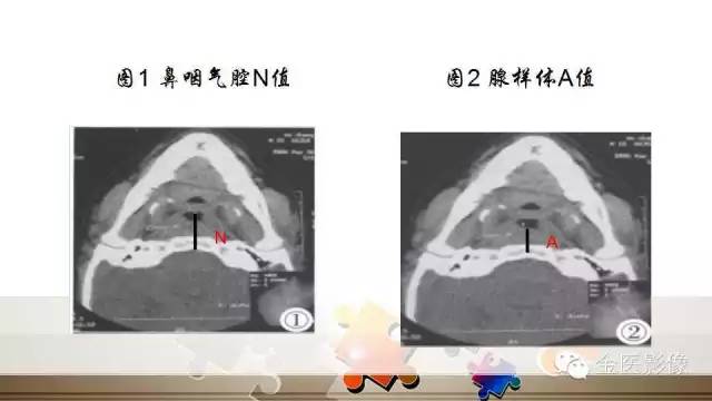 腺样体肥大的影像诊断